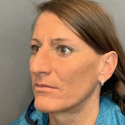 Before Image: Rhinoplasty by Dr. Henstrom - left-front-oblique