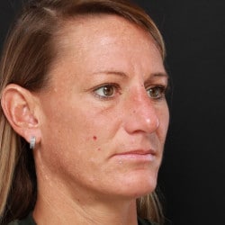 After Image: Rhinoplasty by Dr. Henstrom - right-front-oblique