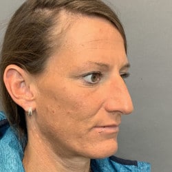 Before Image: Rhinoplasty by Dr. Henstrom - right-front-oblique