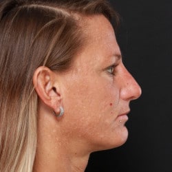 After Image: Rhinoplasty by Dr. Henstrom - right-side