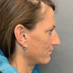 Before Image: Rhinoplasty by Dr. Henstrom - right-side