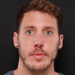 After Image: Septorhinoplasty by Dr. Henstrom - front