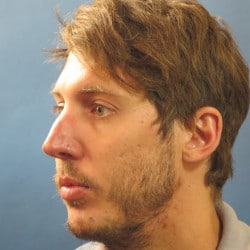 Before Image: Septorhinoplasty by Dr. Henstrom - left-front-oblique