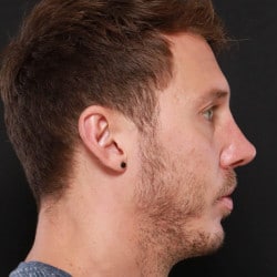 After Image: Septorhinoplasty by Dr. Henstrom - right-side
