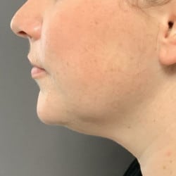 Kybella