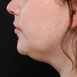 Kybella