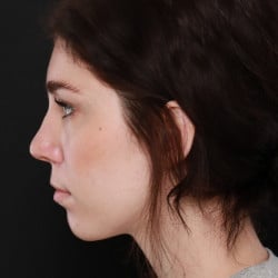 After Image: Rhinoplasty by Dr. Thompson - left-side