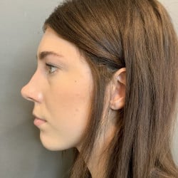 Before Image: Rhinoplasty by Dr. Thompson - left-side