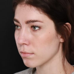 After Image: Rhinoplasty by Dr. Thompson - left-front-oblique