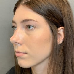 Before Image: Rhinoplasty by Dr. Thompson - left-front-oblique