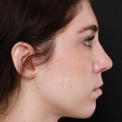 After Image: Rhinoplasty by Dr. Thompson - right-side