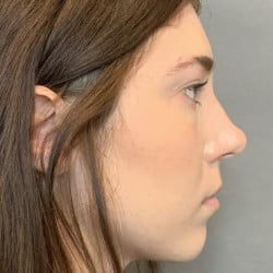 Before Image: Rhinoplasty by Dr. Thompson - right-side
