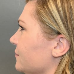 After Image: Rhinoplasty by Dr. Henstrom - left-side