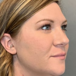 After Image: Rhinoplasty by Dr. Henstrom - right-front-oblique