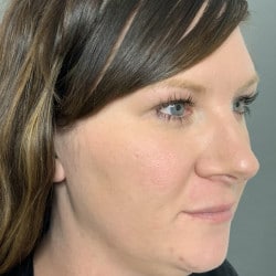 Before Image: Rhinoplasty by Dr. Henstrom - right-front-oblique