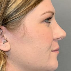 After Image: Rhinoplasty by Dr. Henstrom - right-side