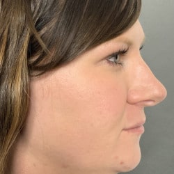 Before Image: Rhinoplasty by Dr. Henstrom - right-side