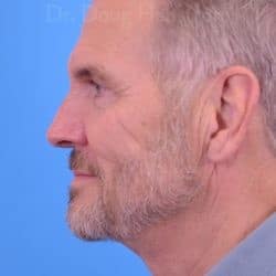 After Image: Direct Necklift by Dr. Henstrom – 913 - left-side