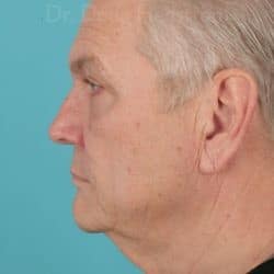 Before Image: Direct Necklift by Dr. Henstrom – 913 - left-side