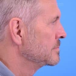 After Image: Direct Necklift by Dr. Henstrom – 913 - right-side