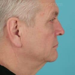 Before Image: Direct Necklift by Dr. Henstrom – 913 - right-side