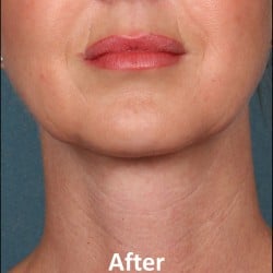 After Image: Kybella Before & After Photos | 989 - front