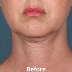 Before Image: Kybella Before & After Photos | 989 - front