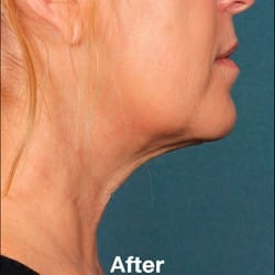 After Image: Kybella Before & After Photos | 990 - right-side