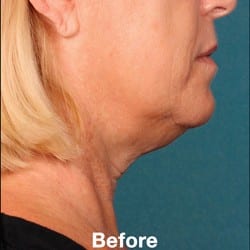 Before Image: Kybella Before & After Photos | 990 - right-side