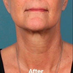 After Image: Kybella Before & After Photos | 991 - front