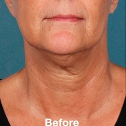 Before Image: Kybella Before & After Photos | 991 - front