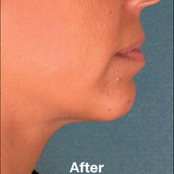 After Image: Kybella Before & After Photos | 993 - right-side