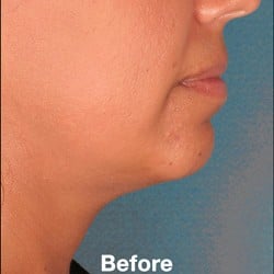 Before Image: Kybella Before & After Photos | 993 - right-side