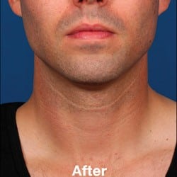 Fotos de antes y después de Kybella | 994