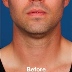 Before Image: Kybella Before & After Photos | 994 - front