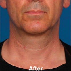 After Image: Kybella Before & After Photos | 995 - front