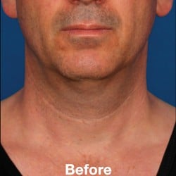 Before Image: Kybella Before & After Photos | 995 - front