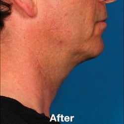 After Image: Kybella Before & After Photos | 995 - right-side