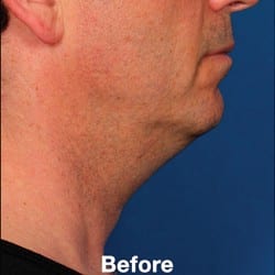 Before Image: Kybella Before & After Photos | 995 - right-side