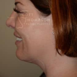 Kybella – 206 | Utah Facial Plastics