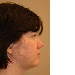 After Image: Surgical Procedures Patient 26673 - right-side