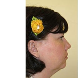 Before Image: Surgical Procedures Patient 26673 - right-side