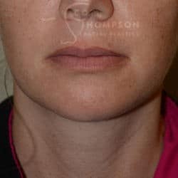 After Image: Submental Liposuction – 655 - front