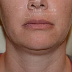 Before Image: Submental Liposuction – 655 - front