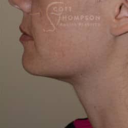 After Image: Submental Liposuction – 655 - left-side