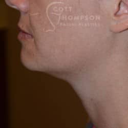 Before Image: Submental Liposuction – 655 - left-side