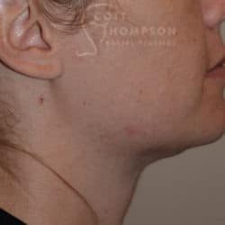 After Image: Submental Liposuction – 655 - right-side