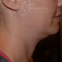 Before Image: Submental Liposuction – 655 - right-side