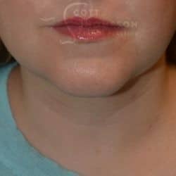 After Image: Submental Liposuction by Dr. Thompson – 906 - front