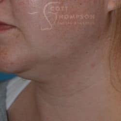Before Image: Submental Liposuction by Dr. Thompson – 906 - left-front-oblique